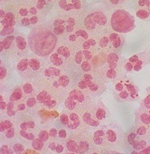 脑膜炎双球菌属奈瑟氏菌属,是寄居在人体鼻咽部的一种革兰氏阴性菌