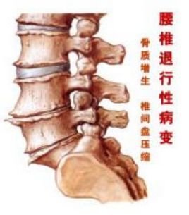 腰椎退行性变_360百科