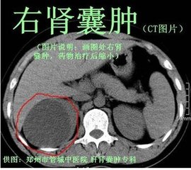 右肾囊肿