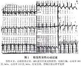 室上性心动过速