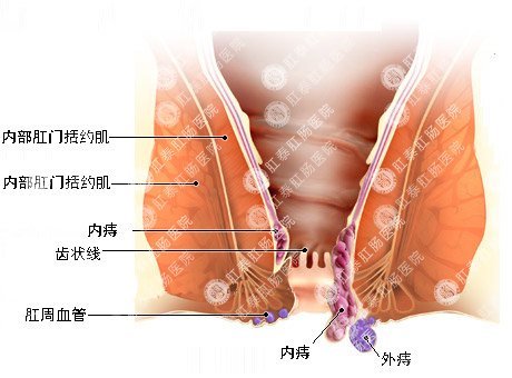 血栓性外痔