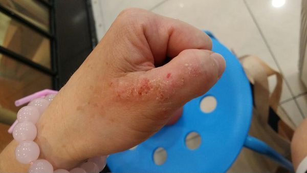 手上的湿疹已经好多年了,一到了夏天那是又痒