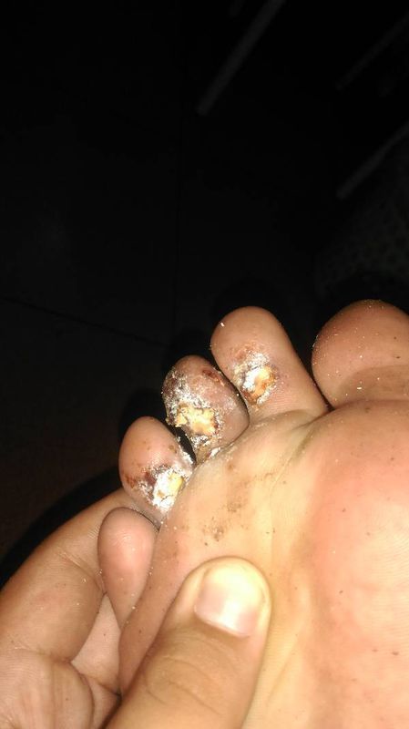 脚上的脚趾溃烂_360问答