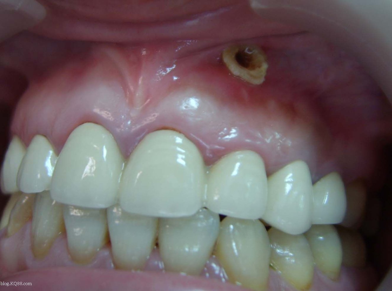 根尖囊肿生长很慢,多无自觉症状,由于患牙牙骺已坏死,牙体变色,呈深