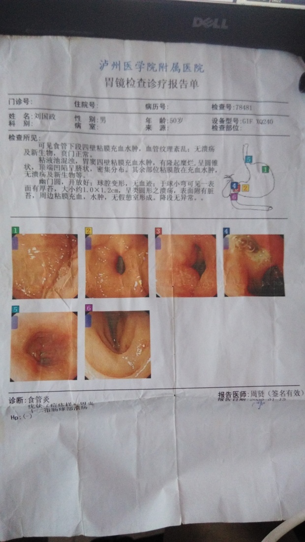 胃鏡下射頻治療疣狀胃炎76例觀察